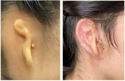 Surgeons transplant 3D ear made of living cells.jpg Surgeons transplant 3D ear made of living cells.jpg